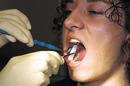 Vattarolni fogászati NOBADENT Ø 1,2 x 4,0 cm