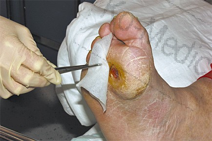 Vazelinnel impregnált kötszer NOBACUTIS 7x7 cm