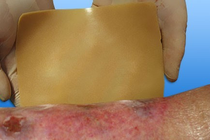 Hidrokolloid kötszer NOBACOLLOID 5x5 cm